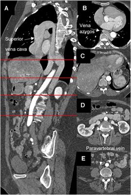 Case Report: Incidental finding of an atresia of the inferior vena cava—a challenge for cardiac surgery